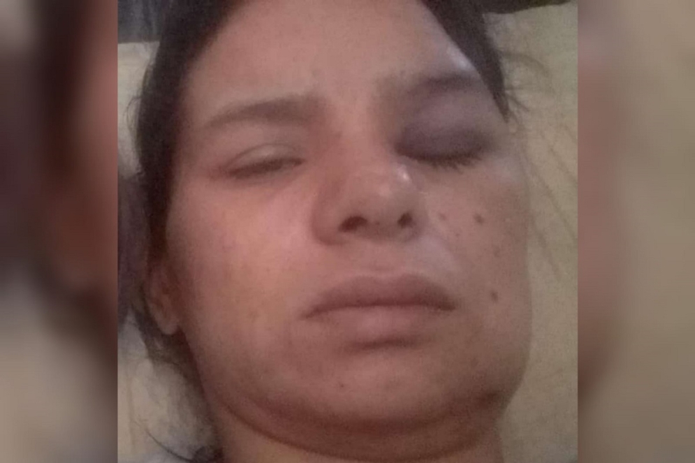 A&uacute;n permanece con su "ojo en compota".