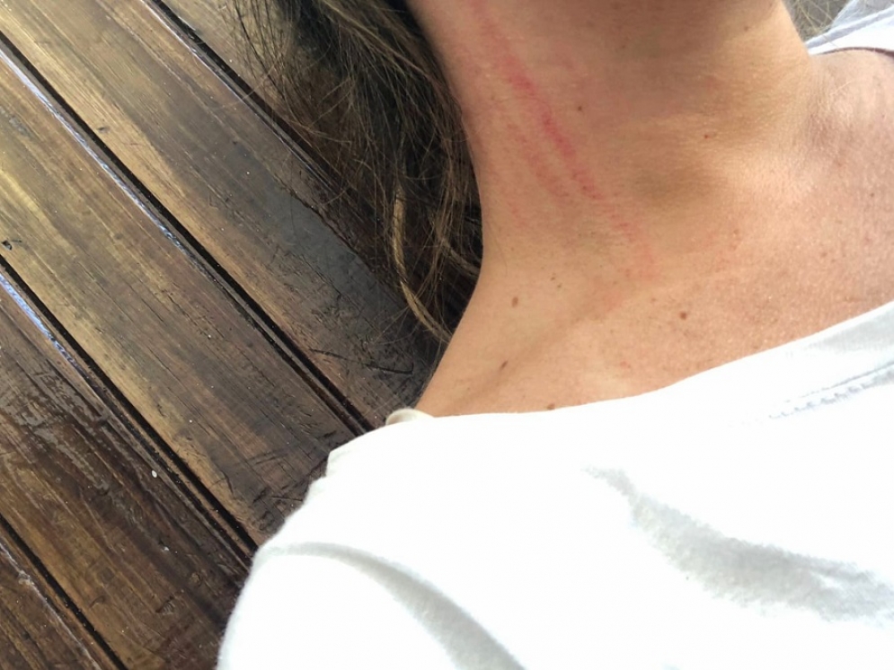 Algunas marcas de la agresi&oacute;n.