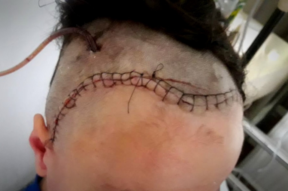 Lautaro esta con alta ambulatoria y se recupera favorablemente. Diariamente viaja al Garrahan, donde le suministran la medicaci&oacute;n v&iacute;a cat&eacute;ter.