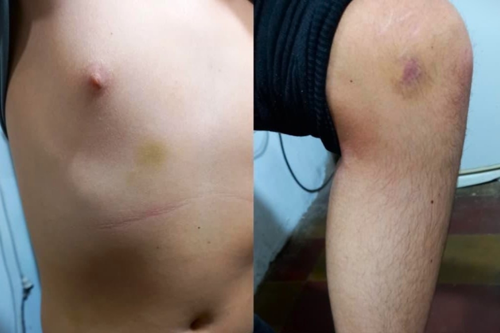 Los hematomas en el cuerpo del menor. 
